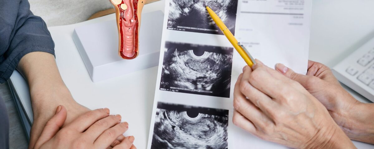 sindrome-ovario-poliquistico-sintomas